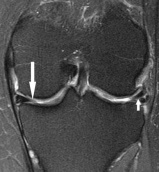 159px-MRI_for_meniscus_tear.jpg